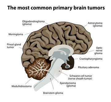 Рак мозга - виды опухолей